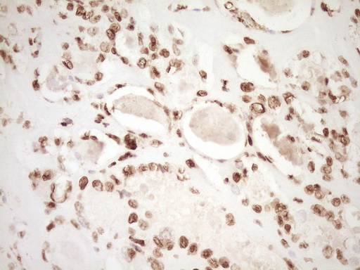 SAE1 Antibody - Immunohistochemical staining of paraffin-embedded Carcinoma of Human thyroid tissue using anti-SAE1 mouse monoclonal antibody. (Heat-induced epitope retrieval by 1 mM EDTA in 10mM Tris, pH8.5, 120C for 3min,