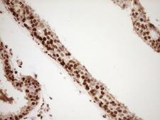 SAE1 Antibody - Immunohistochemical staining of paraffin-embedded Adenocarcinoma of Human breast tissue using anti-SAE1 mouse monoclonal antibody. (Heat-induced epitope retrieval by 1 mM EDTA in 10mM Tris, pH8.5, 120C for 3min,