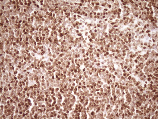 SAE1 Antibody - Immunohistochemical staining of paraffin-embedded Human lymphoma tissue using anti-SAE1 mouse monoclonal antibody. (Heat-induced epitope retrieval by 1 mM EDTA in 10mM Tris, pH8.5, 120C for 3min,