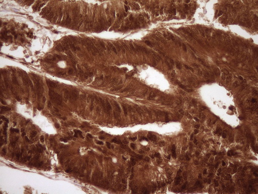 SAE1 Antibody - Immunohistochemical staining of paraffin-embedded Adenocarcinoma of Human colon tissue using anti-SAE1 mouse monoclonal antibody. (Heat-induced epitope retrieval by 1 mM EDTA in 10mM Tris, pH8.5, 120C for 3min,