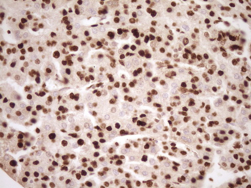 SAE1 Antibody - Immunohistochemical staining of paraffin-embedded Carcinoma of Human liver tissue using anti-SAE1 mouse monoclonal antibody. (Heat-induced epitope retrieval by 1 mM EDTA in 10mM Tris, pH8.5, 120C for 3min,