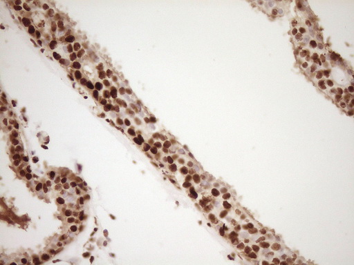 SAE1 Antibody - IHC of paraffin-embedded Adenocarcinoma of Human breast tissue using anti-SAE1 mouse monoclonal antibody. (Heat-induced epitope retrieval by 1 mM EDTA in 10mM Tris, pH8.5, 120°C for 3min).