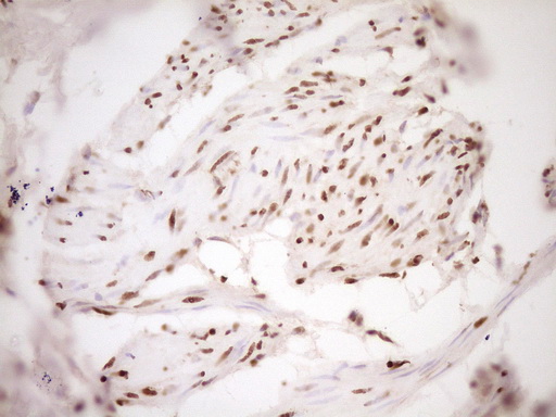 SAE1 Antibody - IHC of paraffin-embedded Carcinoma of Human bladder tissue using anti-SAE1 mouse monoclonal antibody. (Heat-induced epitope retrieval by 1 mM EDTA in 10mM Tris, pH8.5, 120°C for 3min).