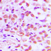 SAE1 Antibody - Immunohistochemical analysis of SAE1 staining in human breast cancer formalin fixed paraffin embedded tissue section. The section was pre-treated using heat mediated antigen retrieval with sodium citrate buffer (pH 6.0). The section was then incubated with the antibody at room temperature and detected using an HRP conjugated compact polymer system. DAB was used as the chromogen. The section was then counterstained with hematoxylin and mounted with DPX.