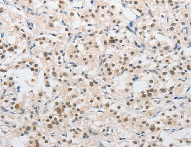 SAE1 Antibody - Immunohistochemistry of paraffin-embedded Human thyroid cancer using SAE1 Polyclonal Antibody at dilution of 1:15.
