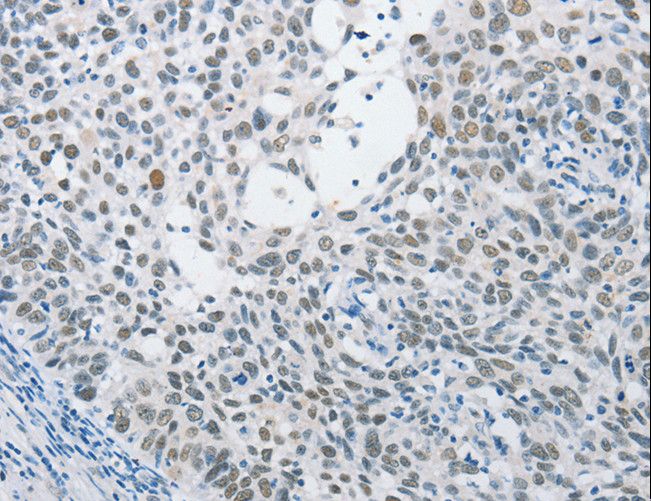 SAE1 Antibody - Immunohistochemistry of paraffin-embedded Human cervical cancer using SAE1 Polyclonal Antibody at dilution of 1:15.