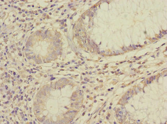 SAE1 Antibody - Immunohistochemistry of paraffin-embedded human colon cancer at dilution 1:100