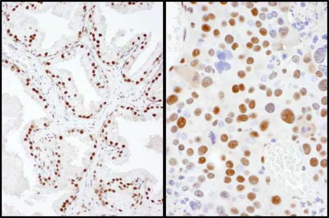 SAE2 / UBA2 Antibody - Detection of Human and Mouse SAE2 by Immunohistochemistry. Sample: FFPE sections of human prostate carcinoma (left) and mouse renal cell carcinoma (right). Antibody: Affinity purified rabbit anti-SAE2 used at a dilution of 1:200 (1 ug/ml). Detection: DAB.