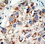 SAE2 / UBA2 Antibody - Formalin-fixed and paraffin-embedded human cancer tissue reacted with the primary antibody, which was peroxidase-conjugated to the secondary antibody, followed by AEC staining. This data demonstrates the use of this antibody for immunohistochemistry; clinical relevance has not been evaluated. BC = breast carcinoma; HC = hepatocarcinoma.