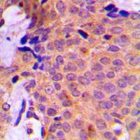 SAE2 / UBA2 Antibody - Immunohistochemical analysis of UBA2 staining in human breast cancer formalin fixed paraffin embedded tissue section. The section was pre-treated using heat mediated antigen retrieval with sodium citrate buffer (pH 6.0). The section was then incubated with the antibody at room temperature and detected using an HRP conjugated compact polymer system. DAB was used as the chromogen. The section was then counterstained with hematoxylin and mounted with DPX.
