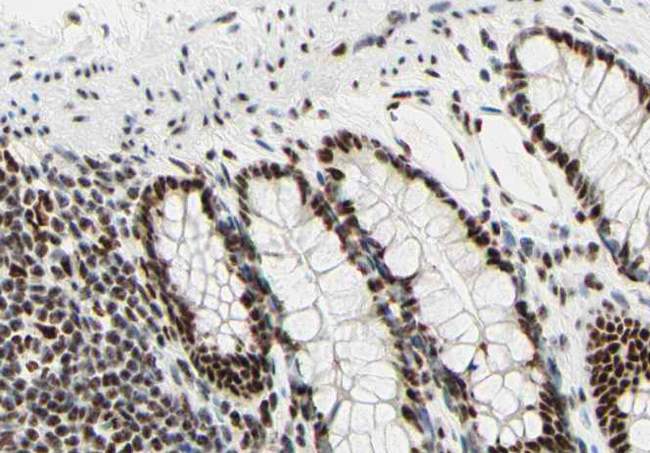 SAE2 / UBA2 Antibody - 1:100 staining human colon tissue by IHC-P. The tissue was formaldehyde fixed and a heat mediated antigen retrieval step in citrate buffer was performed. The tissue was then blocked and incubated with the antibody for 1.5 hours at 22°C. An HRP conjugated goat anti-rabbit antibody was used as the secondary.