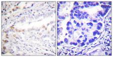 SAE2 / UBA2 Antibody - Peptide - + Immunohistochemistry analysis of paraffin-embedded human lung carcinoma tissue using Uba2 antibody.