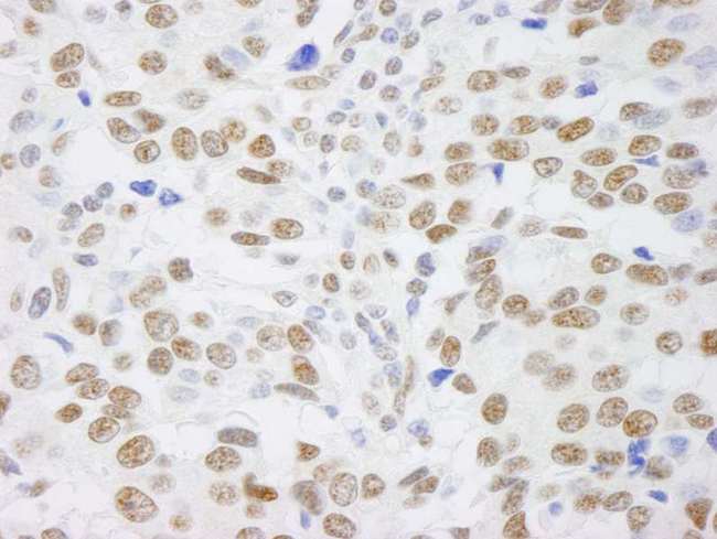 SAFB1 / SAFB Antibody - Detection of Human SAFB1 by Immunohistochemistry. Sample: FFPE section of human breast adenocarcinoma. Antibody: Affinity purified rabbit anti-SAFB1 used at a dilution of 1:250.