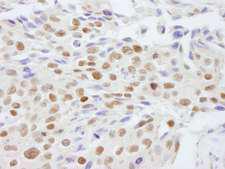 SAFB2 Antibody - Detection of Human SAFB2 by Immunohistochemistry. Sample: FFPE section of human breast carcinoma. Antibody: Affinity purified rabbit anti-SAFB2 used at a dilution of 1:100.