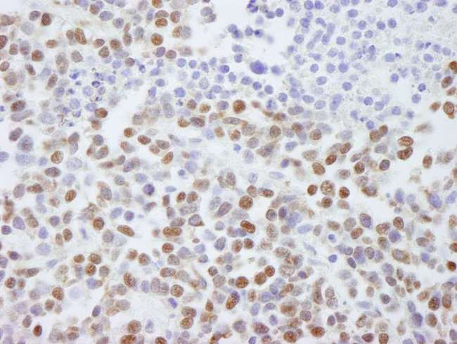 SAFB2 Antibody - Detection of Human SAFB2 by Immunohistochemistry. Sample: FFPE section of non-small cell lung cancer. Antibody: Affinity purified rabbit anti-SAFB2 used at a dilution of 1:500.