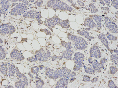 SAHH / AHCY Antibody - Immunohistochemistry of paraffin-embedded human breast cancer using AHCY antibody at dilution of 1:200 (200x lens).