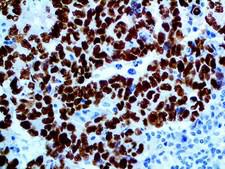 SALL4 Antibody - IHC of SALL4 on an FFPE Testicular Cancer Metastasis to Liver Tissue