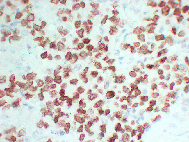 SALL4 Antibody - Seminoma 2 High Magnification
