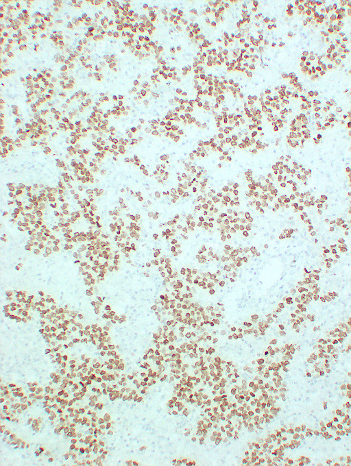 SALL4 Antibody - Seminoma2