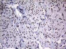 SAMD12 Antibody - Immunohistochemical staining of paraffin-embedded Human endometrium tissue within the normal limits using anti-SAMD12 mouse monoclonal antibody. (Heat-induced epitope retrieval by 1mM EDTA in 10mM Tris buffer. (pH8.5) at 120°C for 3 min. (1:150)