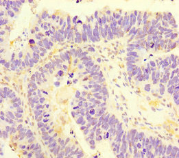 SAMD7 Antibody - Immunohistochemistry of paraffin-embedded human ovarian cancer using SAMD7 Antibody at dilution of 1:100