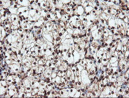 SAMHD1 Antibody - IHC of paraffin-embedded Carcinoma of Human kidney tissue using anti-SAMHD1 mouse monoclonal antibody.