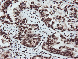 SAMHD1 Antibody - IHC of paraffin-embedded Adenocarcinoma of Human ovary tissue using anti-SAMHD1 mouse monoclonal antibody.