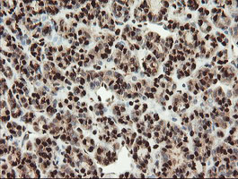 SAMHD1 Antibody - IHC of paraffin-embedded Carcinoma of Human thyroid tissue using anti-SAMHD1 mouse monoclonal antibody.