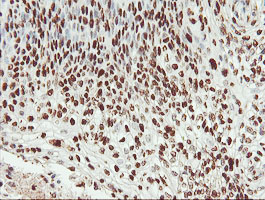SAMHD1 Antibody - IHC of paraffin-embedded Carcinoma of Human bladder tissue using anti-SAMHD1 mouse monoclonal antibody.