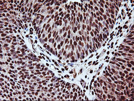 SAMHD1 Antibody - IHC of paraffin-embedded Carcinoma of Human bladder tissue using anti-SAMHD1 mouse monoclonal antibody.