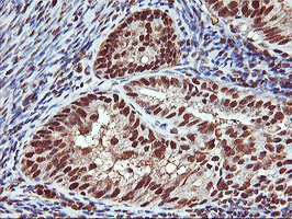 SAMHD1 Antibody - IHC of paraffin-embedded Adenocarcinoma of Human endometrium tissue using anti-SAMHD1 mouse monoclonal antibody.