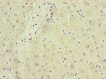 SAMM50 Antibody - Immunohistochemistry of paraffin-embedded human liver cancer at dilution of 1:100