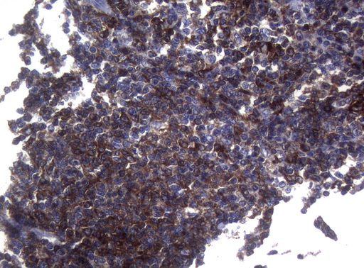 SAMSN1 Antibody - Immunohistochemical staining of paraffin-embedded Human lymphoma tissue using anti-SAMSN1 mouse monoclonal antibody. (Heat-induced epitope retrieval by 1mM EDTA in 10mM Tris buffer. (pH8.5) at 120°C for 3 min. (1:150)