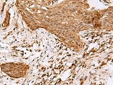 SAMSN1 Antibody - Immunohistochemistry of paraffin-embedded Human esophagus cancer tissue  using SAMSN1 Polyclonal Antibody at dilution of 1:80(×200)