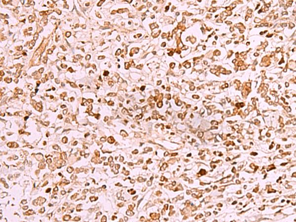 SAMSN1 Antibody - Immunohistochemistry of paraffin-embedded Human gastric cancer tissue  using SAMSN1 Polyclonal Antibody at dilution of 1:50(×200)