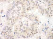 SAP130 Antibody - Detection of Human SAP130 by Immunohistochemistry. Sample: FFPE section of human breast carcinoma. Antibody: Affinity purified rabbit anti-SAP130 used at a dilution of 1:250.
