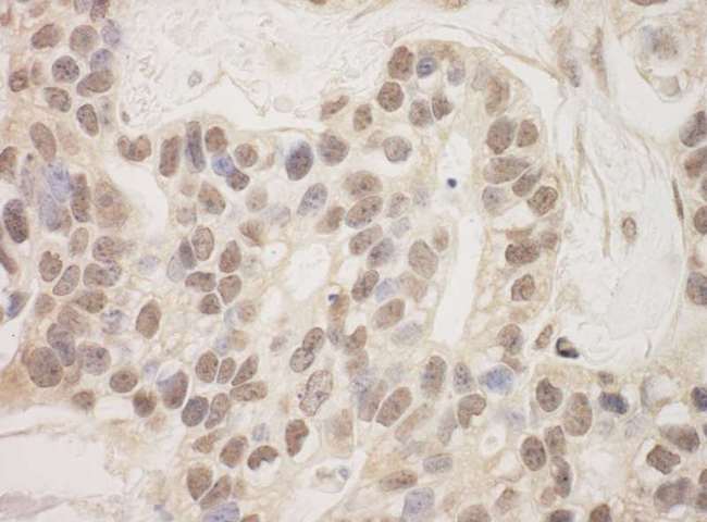 SAP130 Antibody - Detection of Human SAP130 by Immunohistochemistry. Sample: FFPE section of human breast carcinoma. Antibody: Affinity purified rabbit anti-SAP130 used at a dilution of 1:200 (1 ug/ml). Detection: DAB.