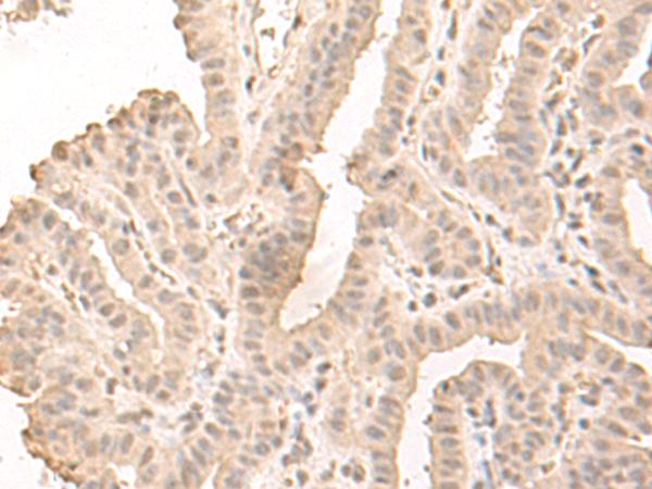 SAP130 Antibody - Immunohistochemistry of paraffin-embedded Human thyroid cancer tissue  using SAP130 Polyclonal Antibody at dilution of 1:50(×200)