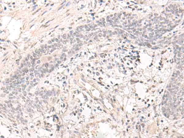SAP130 Antibody - Immunohistochemistry of paraffin-embedded Human esophagus cancer tissue  using SAP130 Polyclonal Antibody at dilution of 1:35(×200)