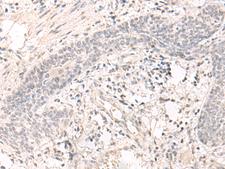 SAP130 Antibody - Immunohistochemistry of paraffin-embedded Human esophagus cancer tissue  using SAP130 Polyclonal Antibody at dilution of 1:35(×200)