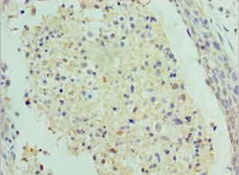 SAP18 Antibody - Immunohistochemistry of paraffin-embedded human cervical cancer using antibody at 1:100 dilution.