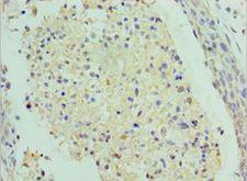 SAP18 Antibody - Immunohistochemistry of paraffin-embedded human cervical cancer using antibody at 1:100 dilution.