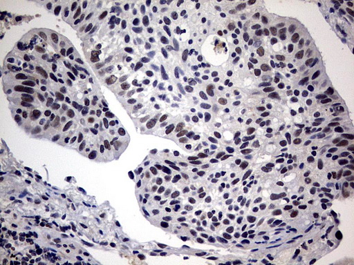 SAP30BP / HTRG Antibody - IHC of paraffin-embedded Carcinoma of Human lung tissue using anti-SAP30BP mouse monoclonal antibody. (Heat-induced epitope retrieval by 10mM citric buffer, pH6.0, 120°C for 3min).