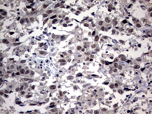 SAP30BP / HTRG Antibody - IHC of paraffin-embedded Adenocarcinoma of Human ovary tissue using anti-SAP30BP mouse monoclonal antibody. (Heat-induced epitope retrieval by 10mM citric buffer, pH6.0, 120°C for 3min).