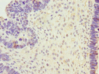 SAP30BP / HTRG Antibody - Immunohistochemistry of paraffin-embedded human ovarian cancer at dilution 1:100