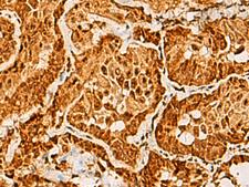 SAP30BP / HTRG Antibody - Immunohistochemistry of paraffin-embedded Human thyroid cancer tissue  using SAP30BP Polyclonal Antibody at dilution of 1:40(×200)