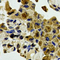 SAPK / JNK / MAPK8 + MAPK9 + MAPK10 Antibody - Immunohistochemical analysis of JNK1/2/3 staining in human lung cancer formalin fixed paraffin embedded tissue section. The section was pre-treated using heat mediated antigen retrieval with sodium citrate buffer (pH 6.0). The section was then incubated with the antibody at room temperature and detected using an HRP polymer system. DAB was used as the chromogen. The section was then counterstained with hematoxylin and mounted with DPX.