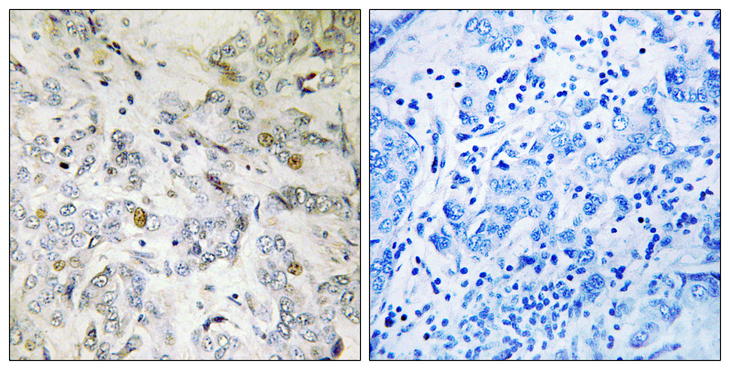 SARNP / Hcc-1 / CIP29 Antibody - Immunohistochemistry analysis of paraffin-embedded human breast carcinoma tissue, using HCC1 Antibody. The picture on the right is blocked with the synthesized peptide.