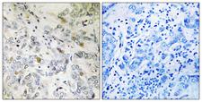 SARNP / Hcc-1 / CIP29 Antibody - Immunohistochemistry analysis of paraffin-embedded human breast carcinoma tissue, using HCC1 Antibody. The picture on the right is blocked with the synthesized peptide.