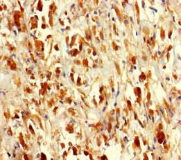 SARS / Serine-tRNA Ligase Antibody - Immunohistochemistry of paraffin-embedded human melanoma using SARS Antibody at dilution of 1:100